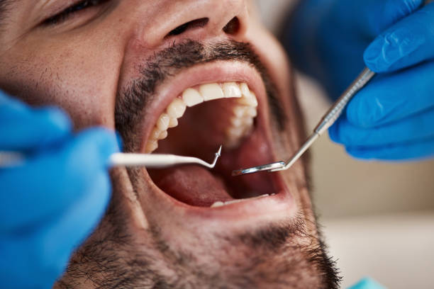 Best Broken or Cracked Tooth Emergency Dentist in North Fork, CA